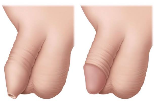 Circumcision - Velura Clinic