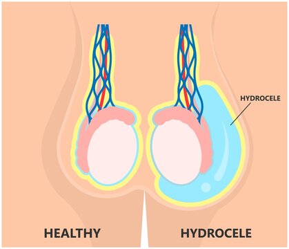 Hydrocele - Velura Clinic