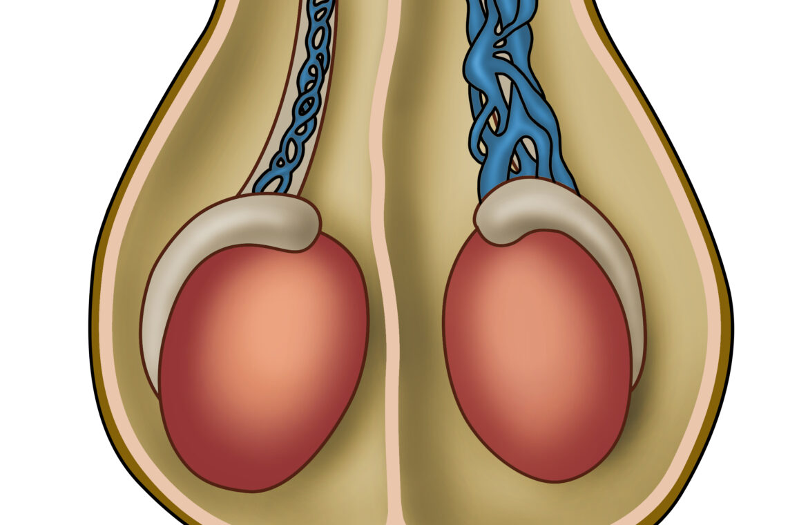Varicocele - Velura Clinic